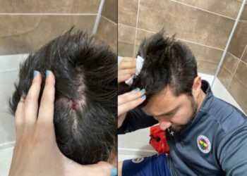 Fenerbahçeli kadın futbolcular kanlar içinde kalırken, Amed tribünlerinden taş ve sopalar atıldığı görüldü. Amed takımından bir oyuncu, yerde yatan Fenerbahçeli kadın futbolcunun başını tekmeledi.